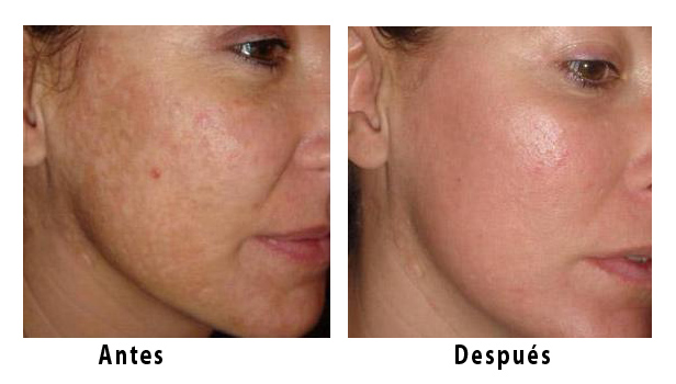 Resultado de imagen para Pulido láser para el acne