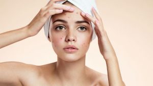 Rutinas del cuidado de la piel con acne