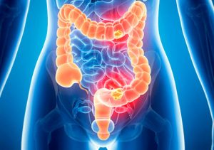 Colon Irritable: ¿cómo enfrentarlo?