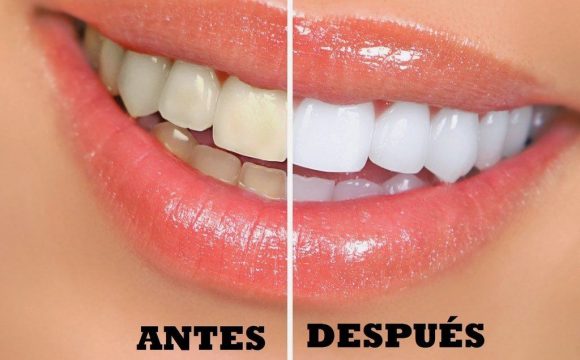 blanquear los dientes