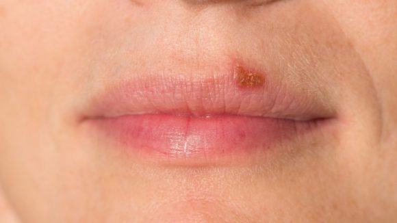 herpes labial