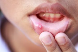 Lo que sabemos sobre el herpes labial en verano