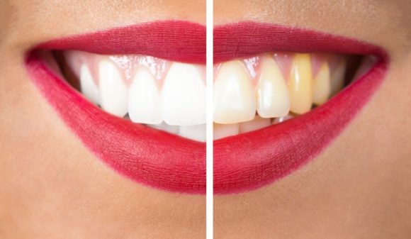 blanquear dientes
