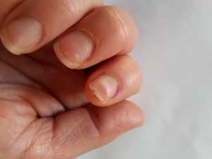 Uñas quebradizas ¿Qué hacer?