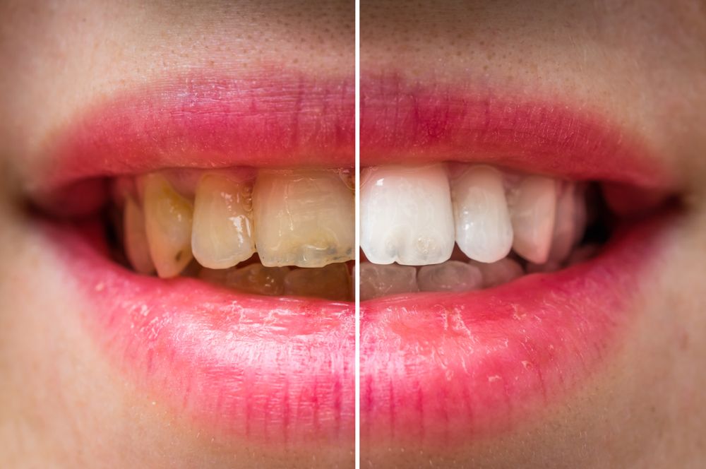 Dientes amarillos ¿Por qué y qué