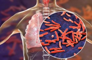 Muertes globales por tuberculosis  aumentan por primera vez en una década