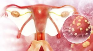 Detectar el cáncer de ovario a tiempo reduce mortalidad