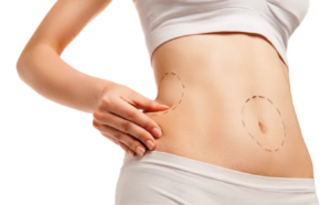 ¿Cuál es el mejor tratamiento?              CoolSculpting® o Liposucción