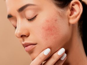 Tratamientos y consejos para combatir el acné